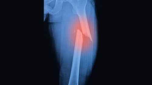 Nhận biết gãy xương kín