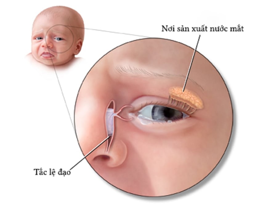 Thông lệ đạo: giải pháp giúp giải quyết bệnh tắc tuyến lệ