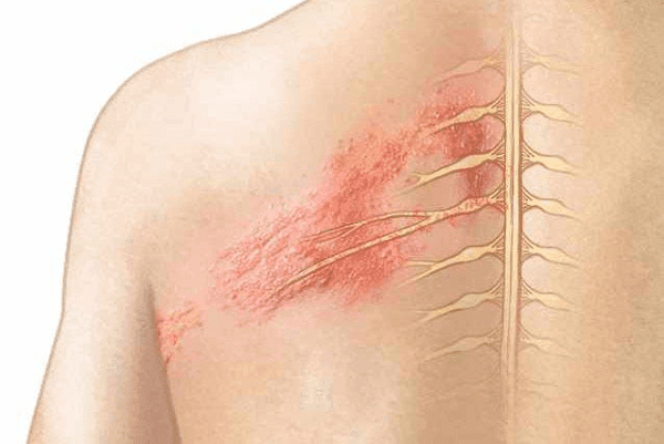 Triệu chứng bệnh zona thần kinh