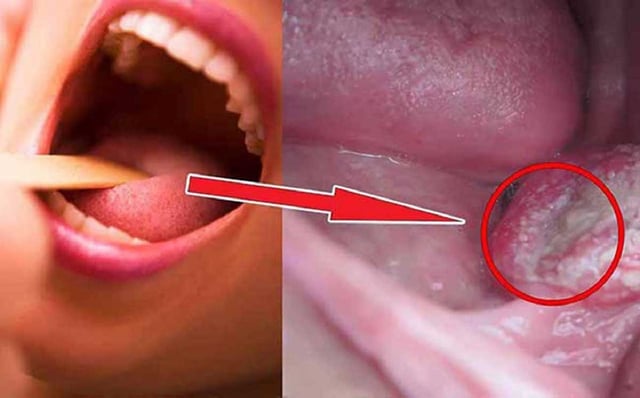 Dấu hiệu ung thư khoang miệng chảy máu bất thường