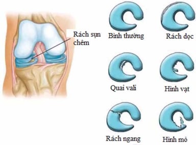 Chi phí mổ rách sụn chêm bao nhiêu?