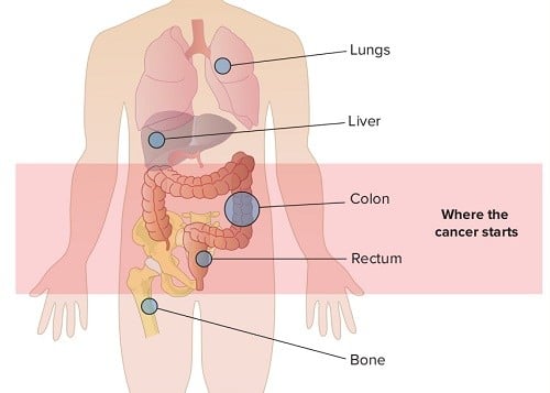 Ung thư tuyến giáp di căn sống được bao lâu?