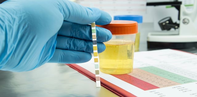 Ý nghĩa của các chỉ số phân tích khi xét nghiệm nước tiểu 10 thông số
