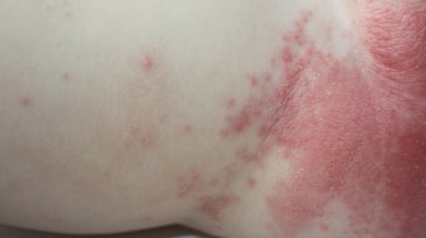 Bé bị dị ứng nổi mẩn đỏ phải làm sao?