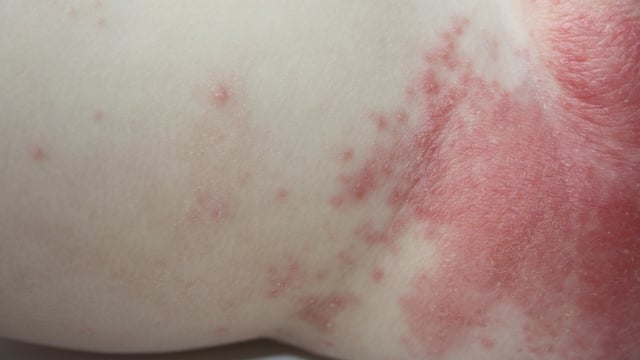Bé bị dị ứng nổi mẩn đỏ phải làm sao?