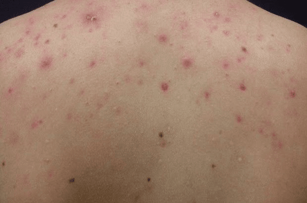 Nóng gan nổi mụn phải làm sao?