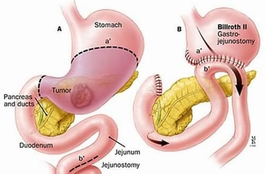 Phẫu thuật nội soi cắt dạ dày