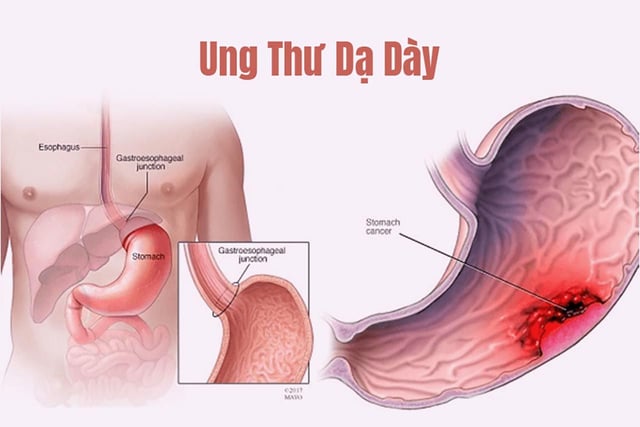 K dạ dày là bệnh gì? bệnh và các phòng tránh