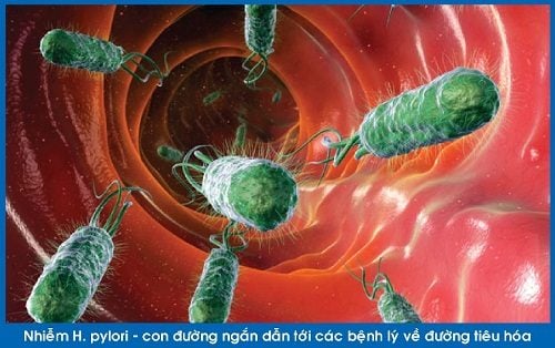 Vi khuẩn HP &#8211; thủ phạm gây hôi miệng