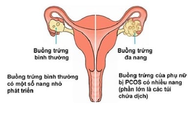 Hội chứng buồng trứng đa nang là gì? Triệu chứng nhận biết