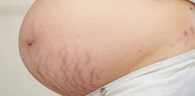 Hình ảnh rạn da khi mang thai biến chứng nguy hiểm