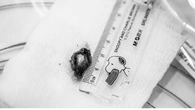 Polyp dạ dày và nguy cơ biến chứng thành ung thư 