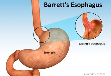 Cảnh giác với bệnh Barrett thực quản