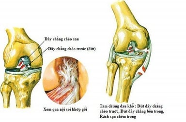 Đứt dây chằng gối nguy hiểm không?