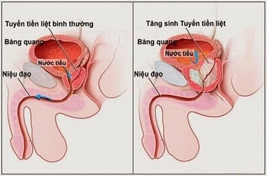 Cách chữa tiểu nhiều lần đúng cách, phù hợp