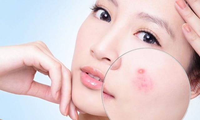 Cần lưu ý gì khi bị nhọt?nhiễm khuẩn huyết