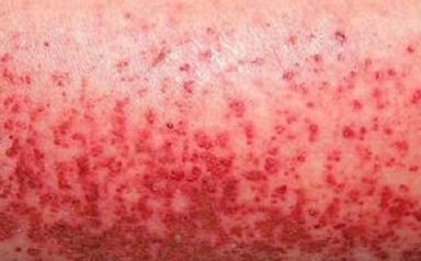 Sốt xuất huyết giảm tiểu cầu