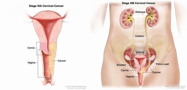 Ung thư tử cung &#8211; những điều cần biết