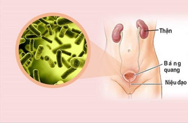 Bạn biết gì về bệnh viêm bàng quang?