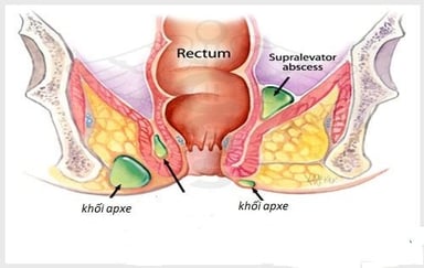 Apxe hậu môn nên ăn gì và kiêng gì?