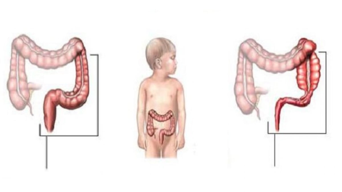 Mổ phình đại tràng bẩm sinh tử vong do không được điều trị