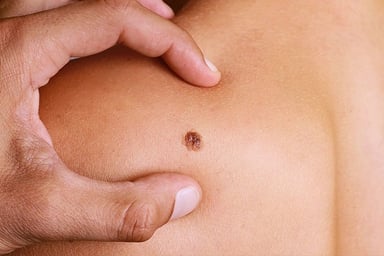 Điều trị ung thư da ở viện nào?