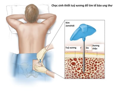 Xét nghiệm sinh thiết là gì? Các loại xét nghiệm sinh thiết
