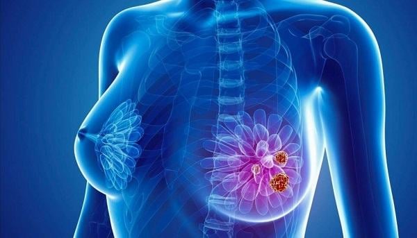 Tiết lộ 5 bệnh ung thư đang gia tăng ở nữ giới trẻ tuổi