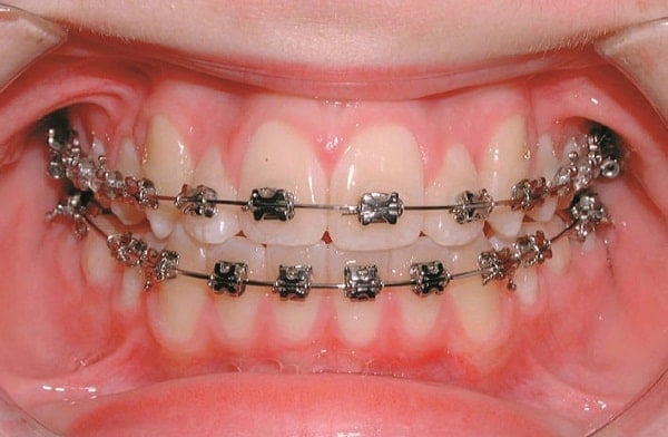 Tìm hiểu về nắn chỉnh răng &#8211; Bí quyết sở hữu răng