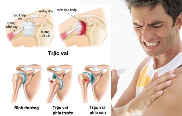 Bệnh viêm khớp vai và cách điều trị hiệu quả tối ưu