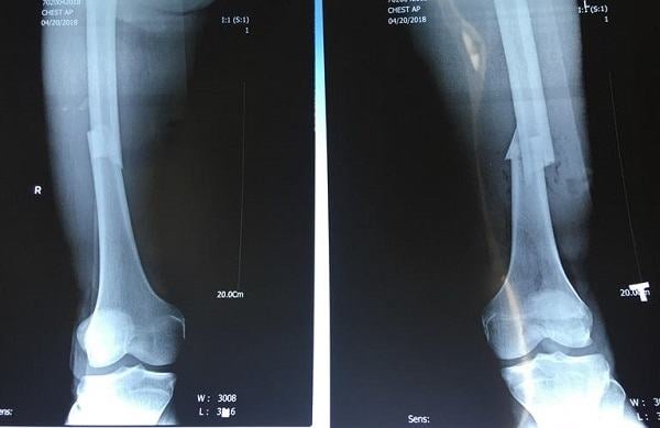 Gãy xương chày bao lâu thì lành? Phụ thuộc vào yếu tố nào?