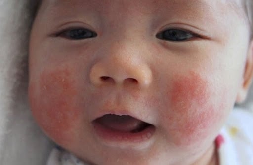 Bệnh chàm ở trẻ em: Hiểu đúng nguyên nhân