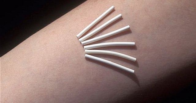 Cấy que tránh thai và một số điều chị em cần biết