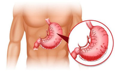Bệnh dạ dày &#8211; quả bom nổ chậm cần tháo ngòi nổ kịp thời