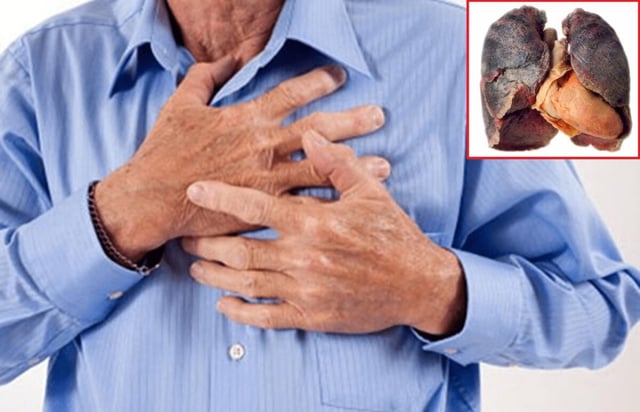 Gói tầm soát ung thư phổi và những điều cần tìm biết