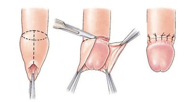 Giải đáp hết thắc mắc về phẫu thuật cắt bao quy đầu 
