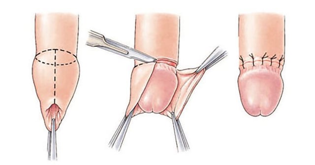 Giải đáp hết thắc mắc về phẫu thuật cắt bao quy đầu 