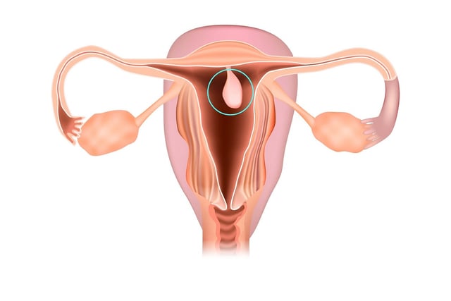 Polyp cổ tử cung: Tìm hiểu triệu chứng, nguyên nhân