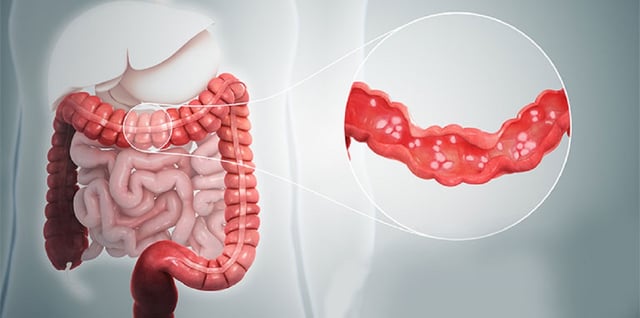 Viêm đại tràng là bệnh gì và cách điều trị hữu hiệu nhất? 
