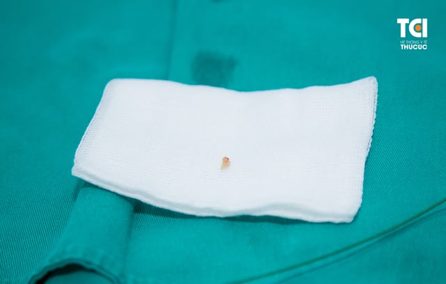 Tán sỏi công nghệ cao ít xâm lấn, sạch sỏi nhanh, êm ái
