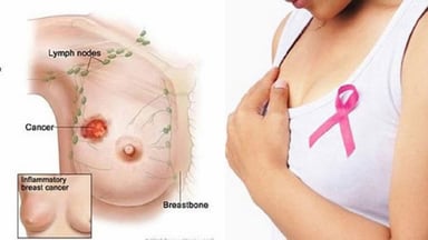 Áp xe vú sau sinh: Bệnh lý phổ biến ở các mẹ bỉm sữa