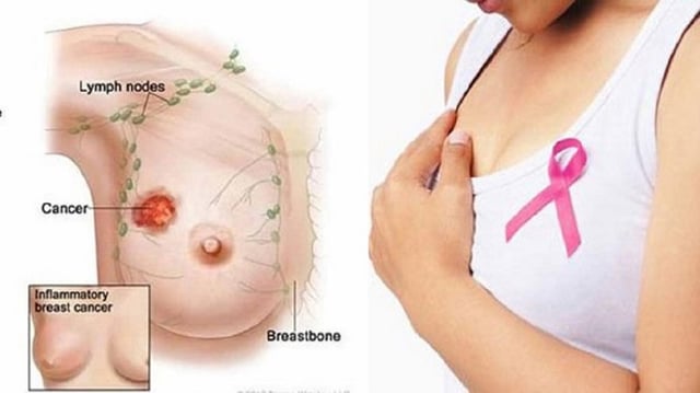 Áp xe vú sau sinh: Bệnh lý phổ biến ở các mẹ bỉm sữa