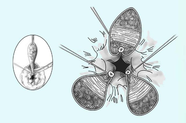 Cắt trĩ theo phương pháp Milligan Morgan: chỉ định và ưu &#8211; nhược điểm