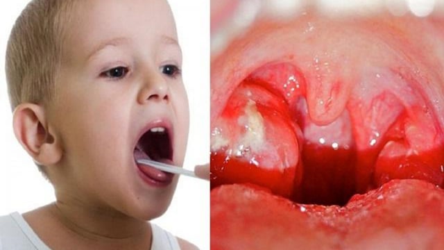 Viêm họng mủ ở trẻ em: những điều ba mẹ cần biết