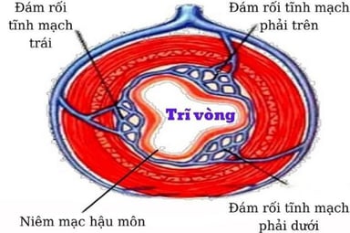 Trĩ vòng là gì? Tìm hiểu phương pháp cắt trĩ vòng hiệu quả