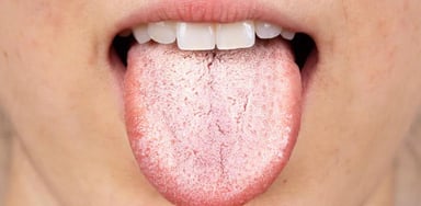 Nấm miệng Candida là bệnh gì?