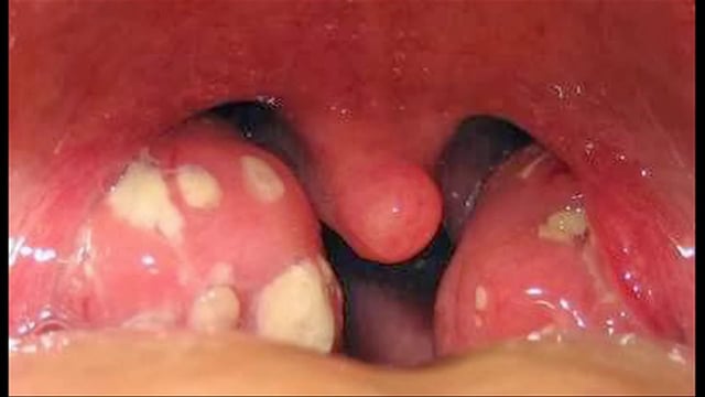 Đừng coi thường viêm amidan cấp mủ