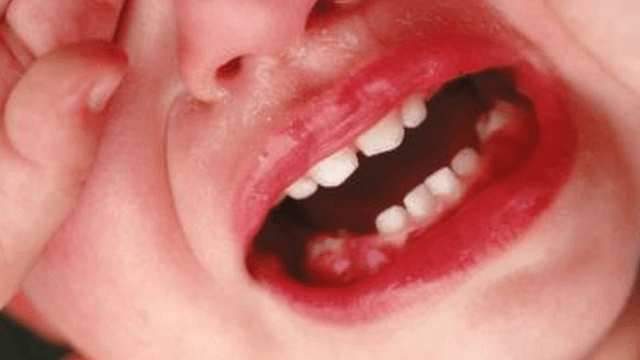 Trẻ bị mưng mủ ở lợi có nguy hiểm không?