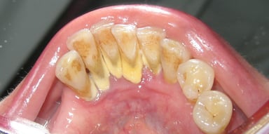 Cao răng nhiều phải làm sao để điều trị?