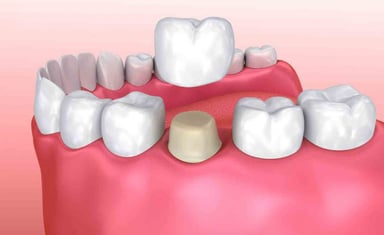Chụp sứ răng hàm là phương pháp gì và được thực hiện thế nào?